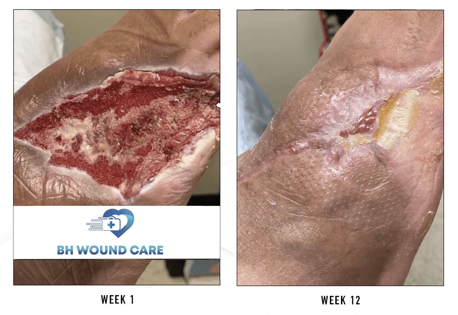 Successful Foot Ulcer Treatment with Gangrene in Sherman Oaks, CA