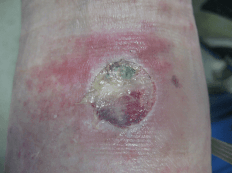 A Close-up View of Non-Healing Wounds Treatments in Sherman Oaks, CA