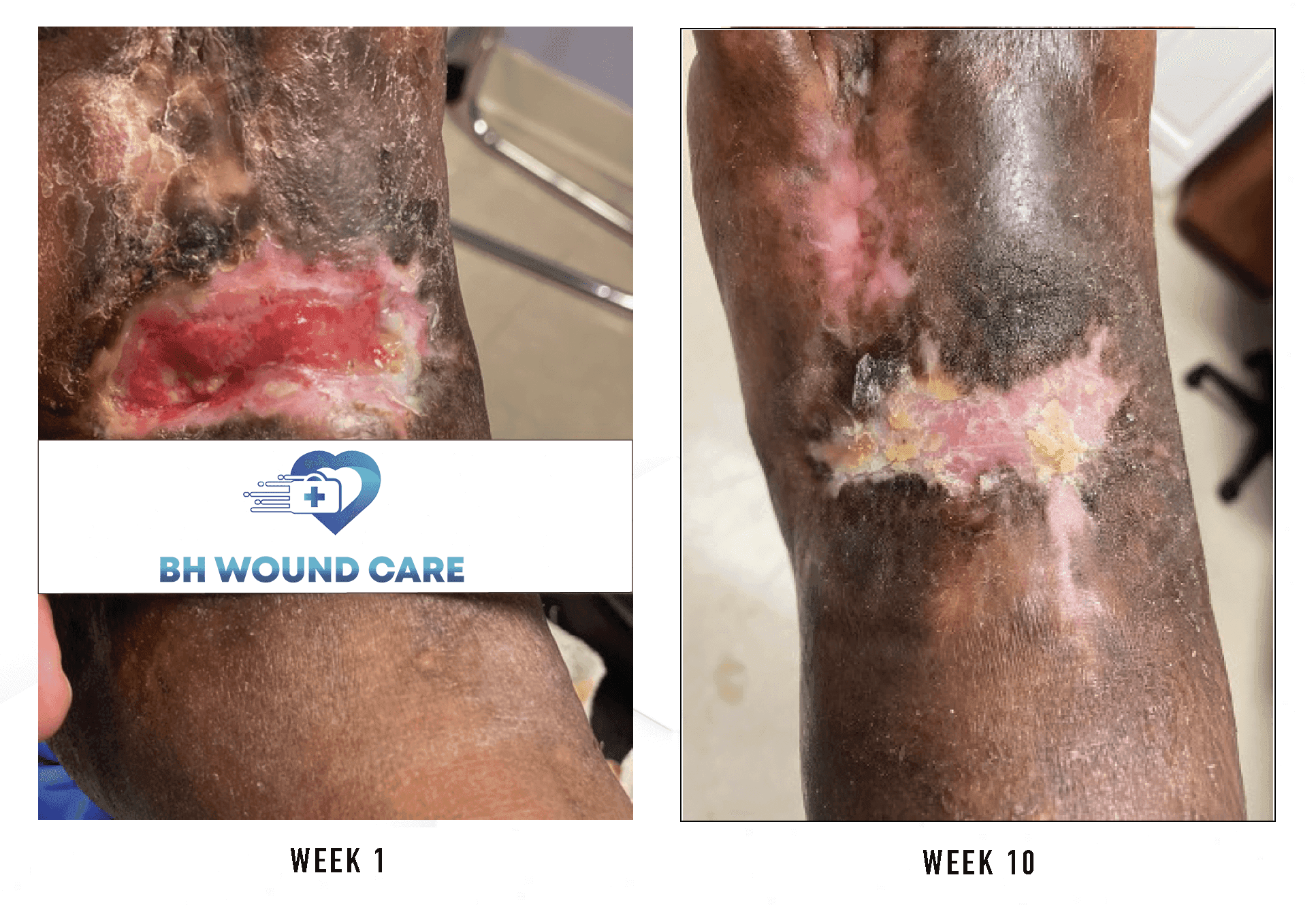 Successful Arterial Ulcer Treatment in a Patient at Sherman Oaks, CA