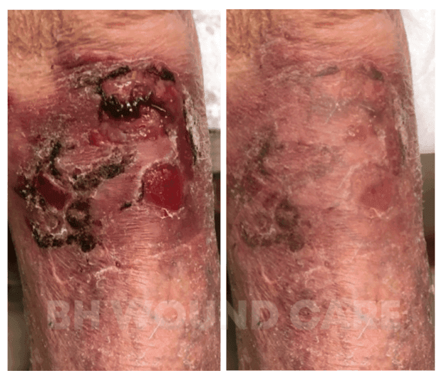 An Old Male Patient with Lower Extremity Wounds Treatments at BH Wounds in Sherman Oaks, CA