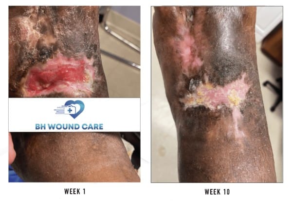 Before and after of successful treatment of an arterial ulcer in Beverly Hills, CA, and Seattle, WA