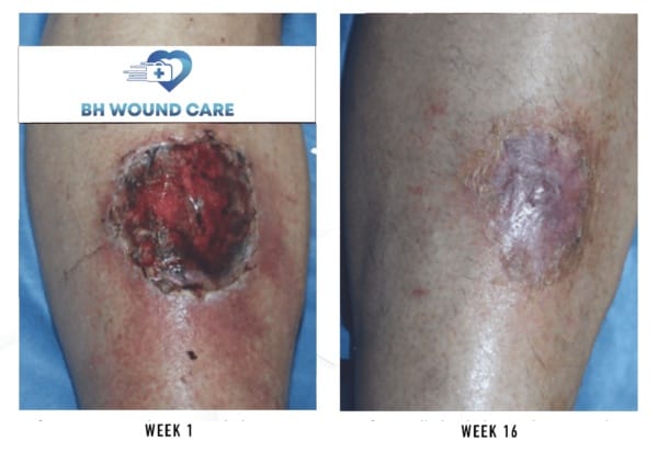 Before and after image of chronic venous leg ulcer treatment in Beverly Hills, CA, and Seattle, WA