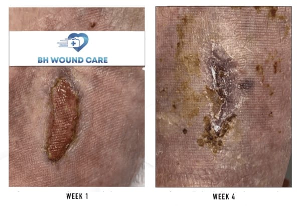 Before and after treatment of chronic venous leg ulcer in Beverly Hills, CA, and Seattle, WA
