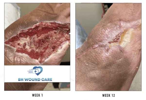 Before and after of successful treatment of a foot ulcer in Beverly Hills, CA, and Seattle, WA
