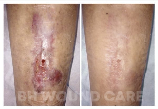 Before and after of a female patient with a diabetic leg wound in Beverly Hills, CA, and Seattle, WA