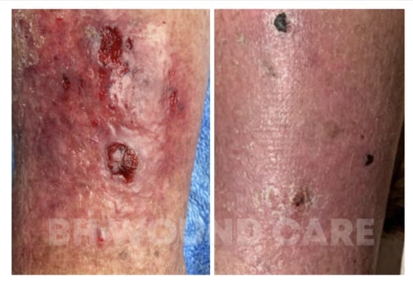 63-Year-Old Female Patient with Chronic Wound in Beverly Hills, CA, and Seattle, WA