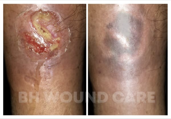 Old Male Patient with Diabetic Leg Ulcer getting treatment in Beverly Hills, CA, and Seattle, WA